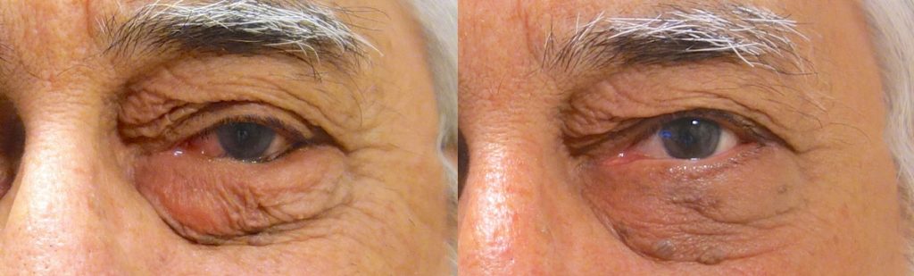 Left Lower Eyelid Entropion Repair Patient 02 