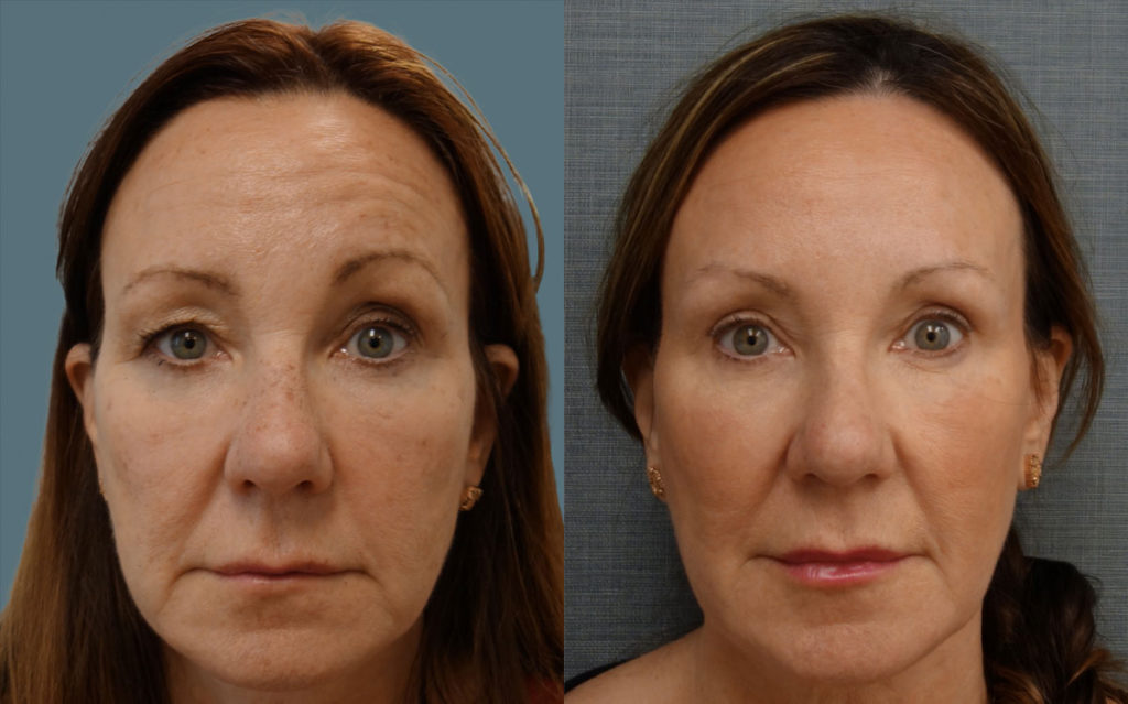 Botox for Brow Asymmetry with Bilateral Upper Eyelid Blepharoplasty Patient 08-A 