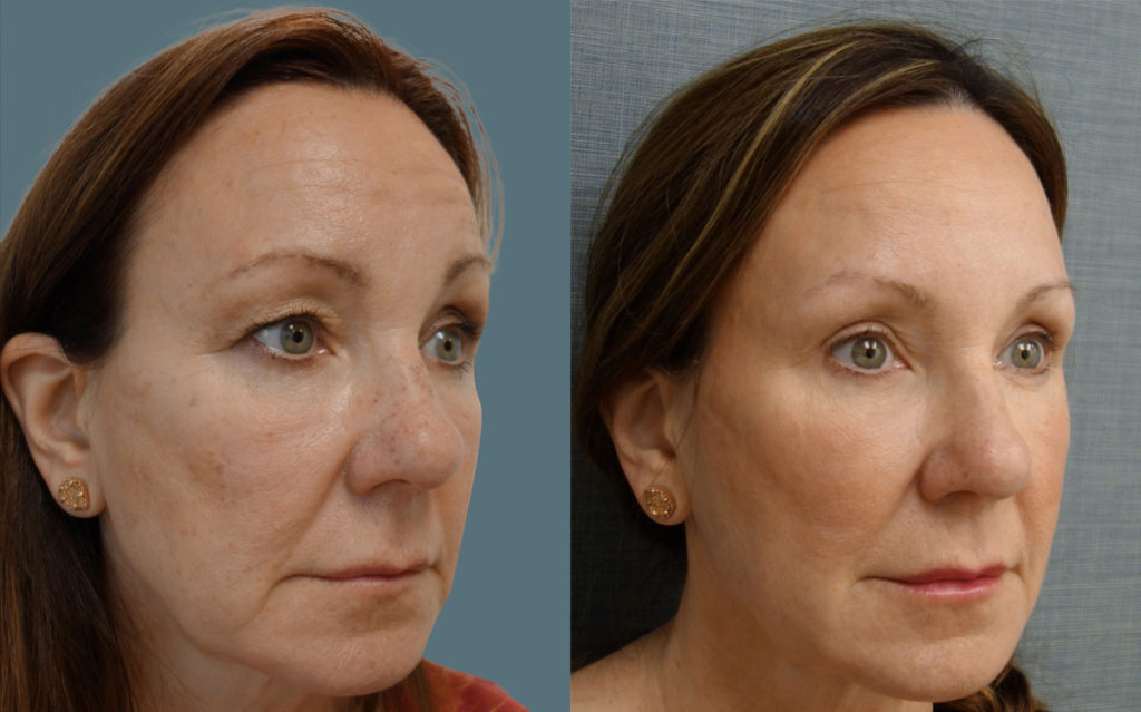 Botox for Brow Asymmetry with Bilateral Upper Eyelid Blepharoplasty Patient 08-B 