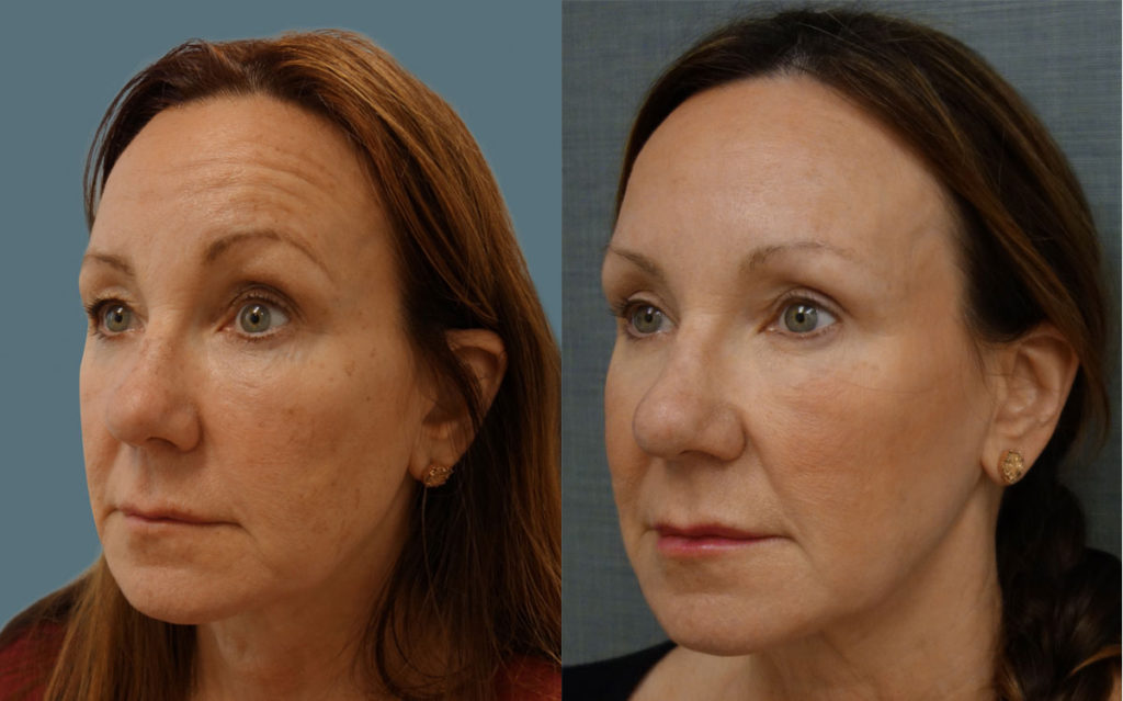 Botox for Brow Asymmetry with Bilateral Upper Eyelid Blepharoplasty Patient 08-C 