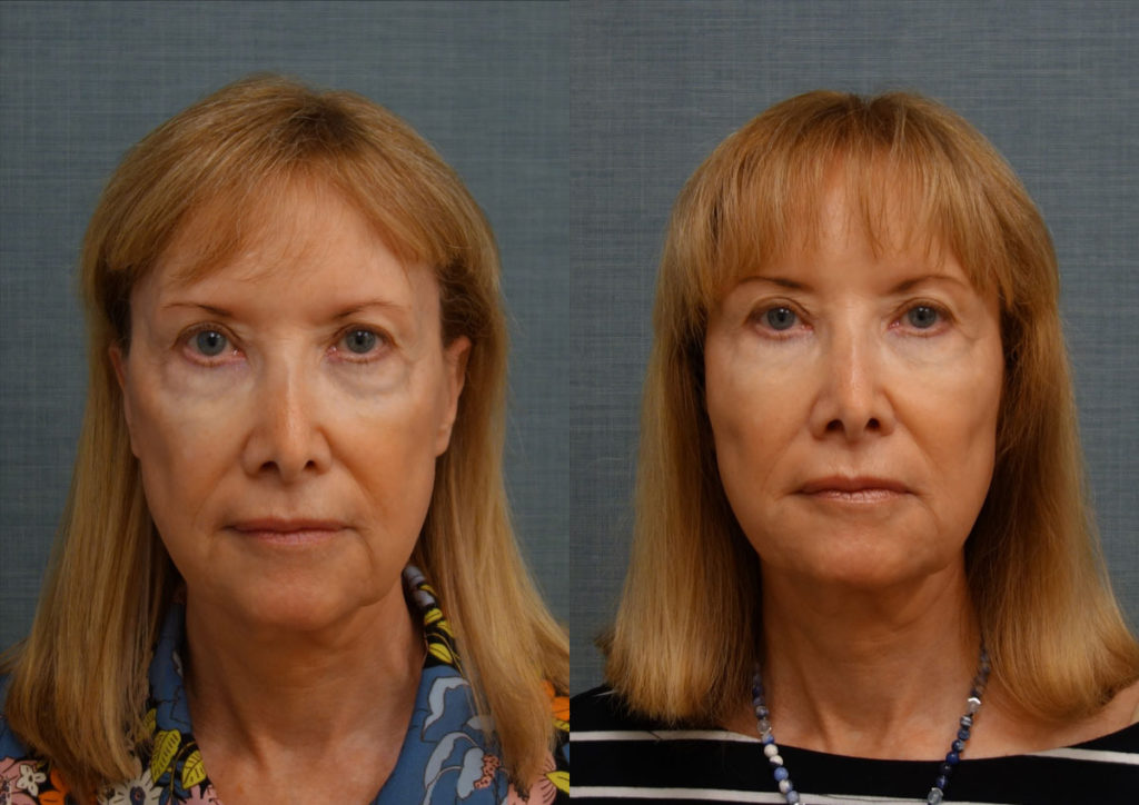 Bilateral Lower Eyelid, Midface, Temple, Marionette Filler and Botox Patient 16 