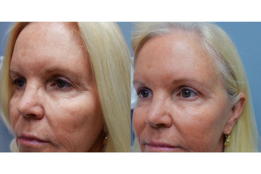 Bilateral Upper Lid Blepharoplasty and Mini Brow Lift Patient 16-B 