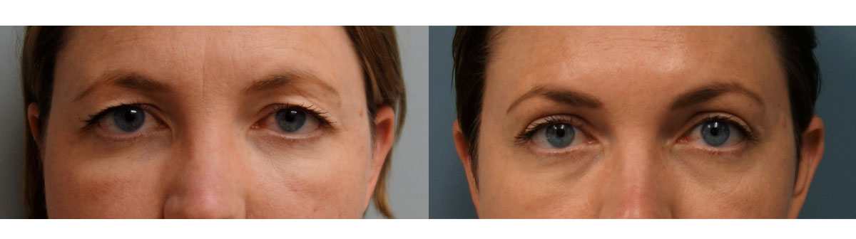 Bilateral Upper Eyelid Blepharoplasty, Left Upper Eyelid Ptosis Repair and Mini Brow Lift Patient 04-C 