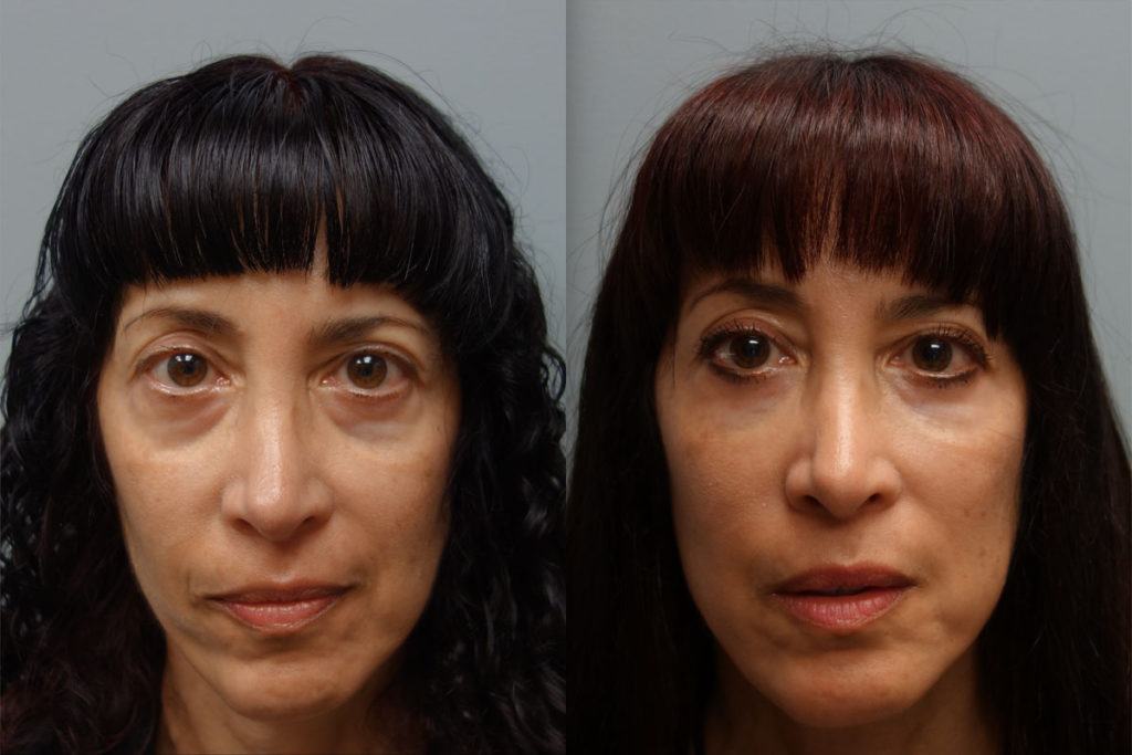 Filler to Lower Eyelids, Cheeks and Mouth - 1 Year Later Patient 05 