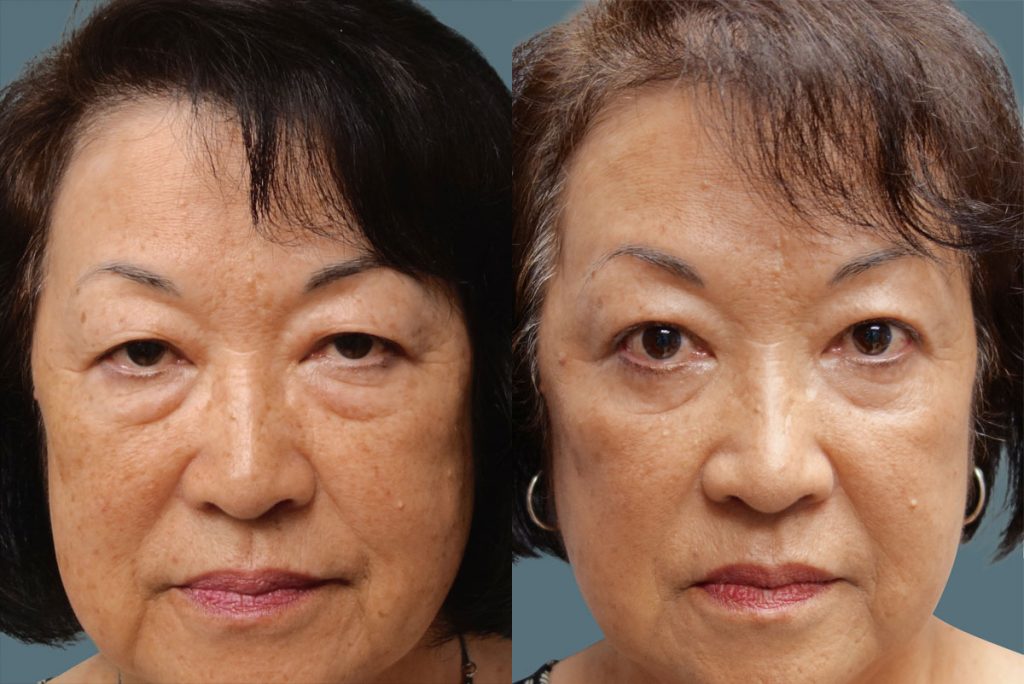 Bilateral Asian Upper Eyelid and Lower Eyelid Blepharoplasty Patient 03-A 