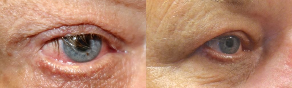 Upper Eyelid Entropion Due To Sleep Apnea - Repair with Eyelash Rotation Patient 01 