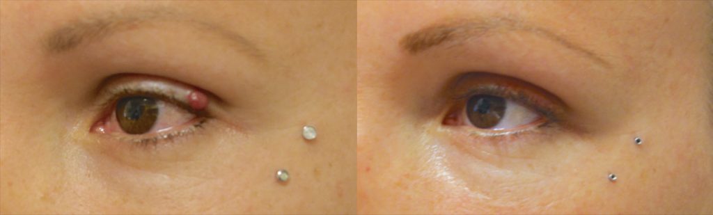 Left Upper Eyelid Growth Removal and Micro Repair Patient 03-A 