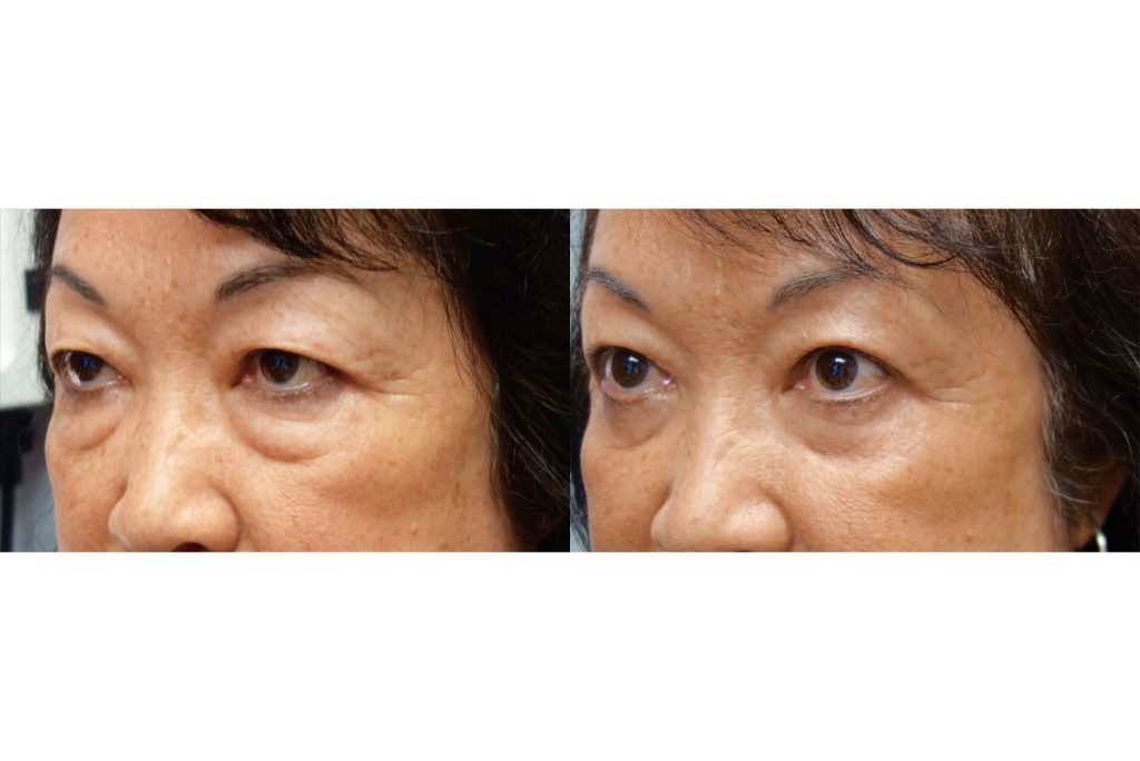 Bilateral Asian Upper Eyelid and Lower Eyelid Blepharoplasty Patient 03-B 