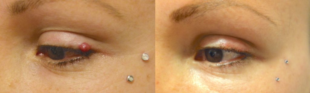 Left Upper Eyelid Growth Removal and Micro Repair Patient 03-B 
