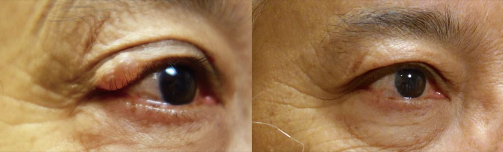 Right Upper Eyelid Complex Cyst Removal with Reconstruction Patient 02-B 