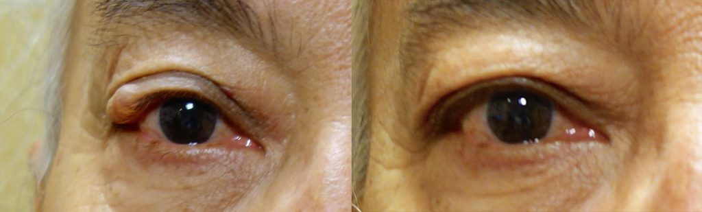 Right Upper Eyelid Complex Cyst Removal with Reconstruction Patient 02-A 
