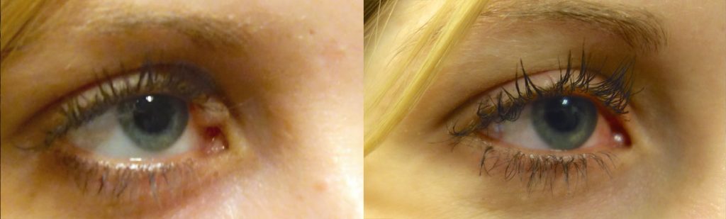 Right Upper Eyelid Growth Removal with Tear Drain Reconstruction Patient 01-B 