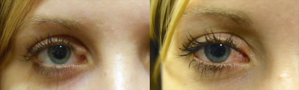Right Upper Eyelid Growth Removal with Tear Drain Reconstruction Patient 01-A 