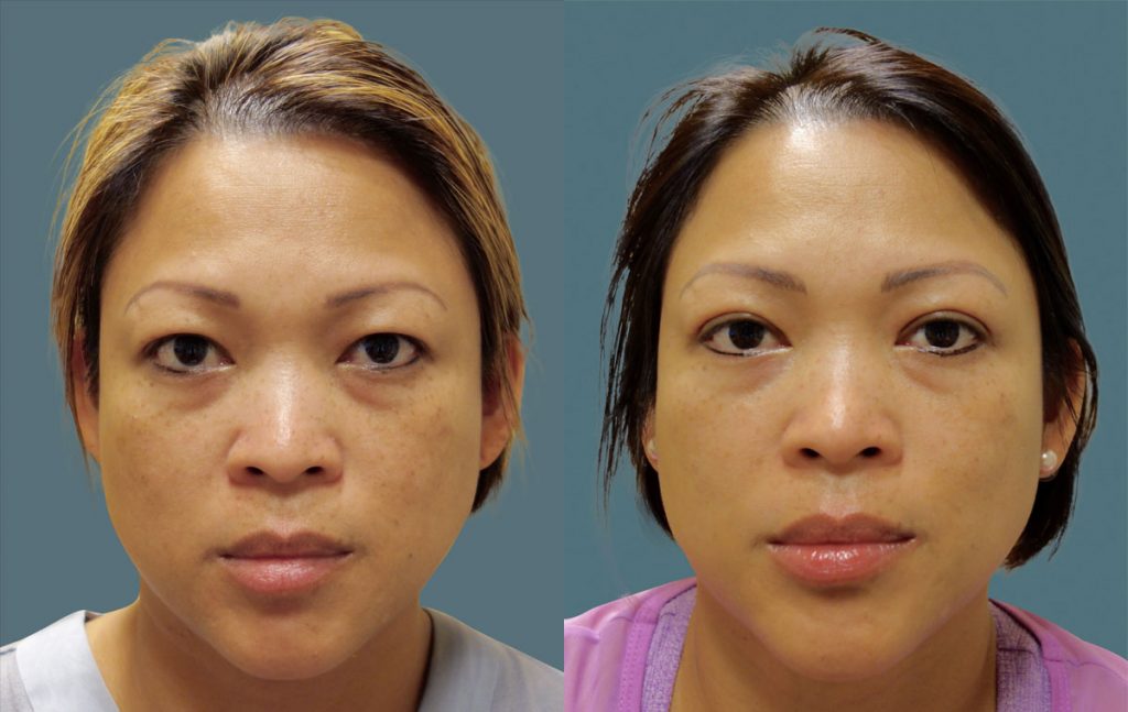 Bilateral Asian Upper Eyelid Blepharoplasty Patient 02-A 