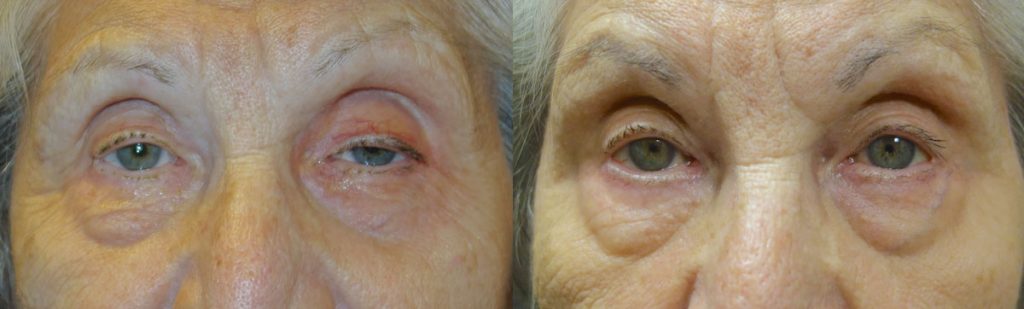 Bilateral Upper Eyelid External Ptosis Repair Patient 12-A 