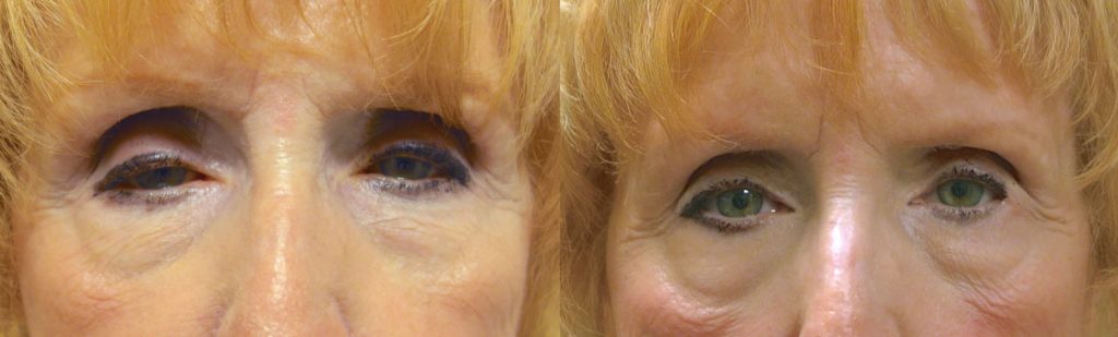 Bilateral Upper Eyelid External Ptosis Repair Patient 16-A 
