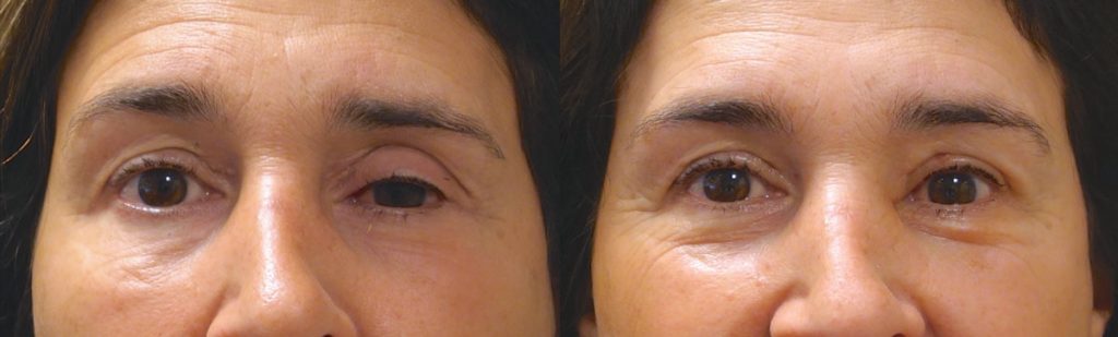 Left Upper Eyelid External Ptosis Repair Patient 06-A 