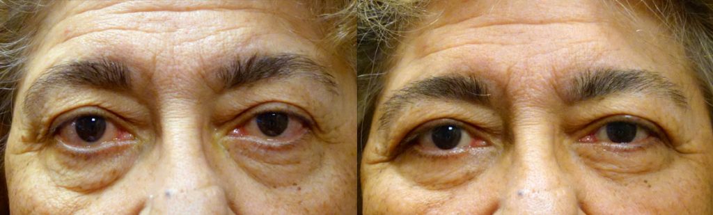 Bilateral Lower Eyelid Retraction Repair with Tightening of Upper and Lower Eyelids for Dry Eye and Exposure Patient 02-A 