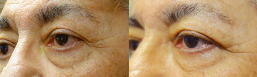 Bilateral Lower Eyelid Retraction Repair with Tightening of Upper and Lower Eyelids for Dry Eye and Exposure Patient 02-B 