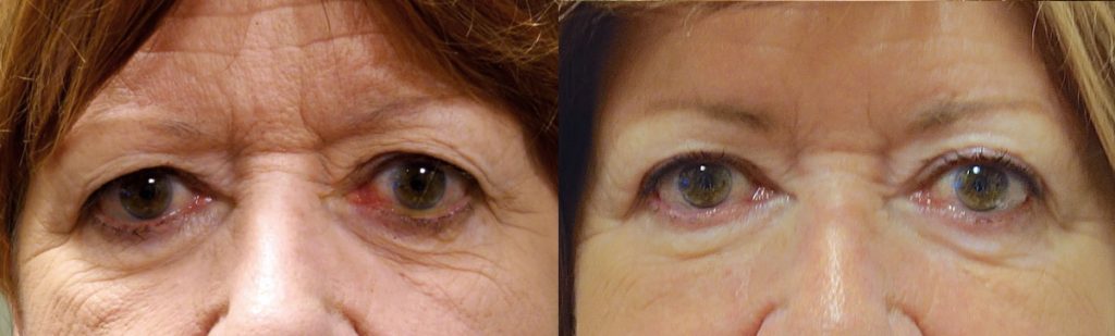 Bilateral Lower Eyelid Retraction Repair, Bilateral Upper Eyelid Blepharoplasty Patient 01 
