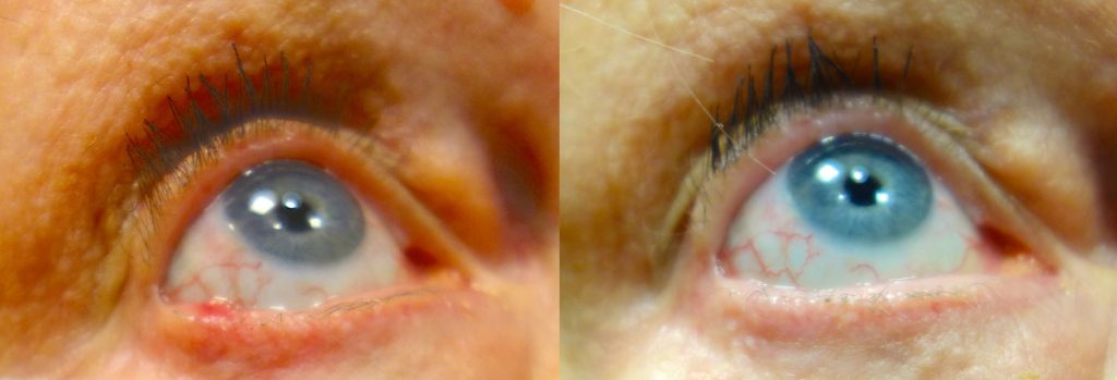 Right Lower Eyelid Basal Cell Cancer Removal with Reconstruction Patient 10 