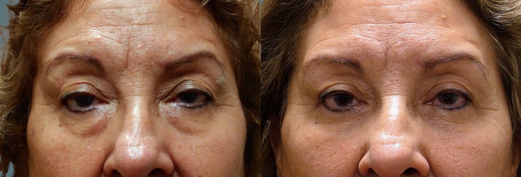 Lower Eyelid Blepharoplasty and Upper Eyelid Ptosis Repair Patient 27-A 