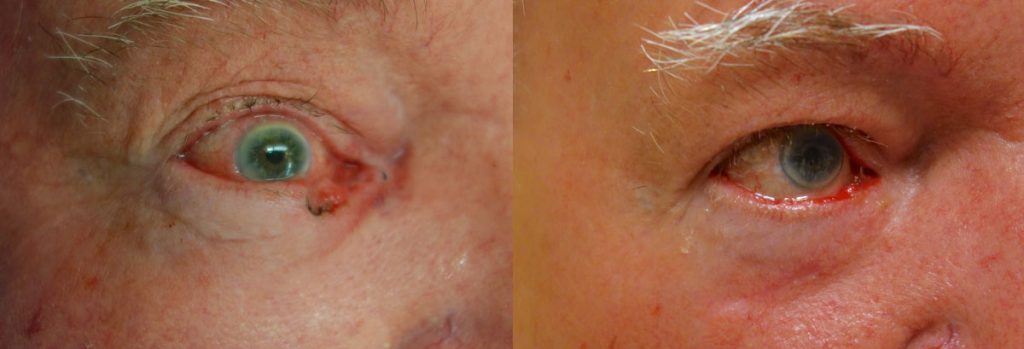 Right Lower Eyelid and lacrimal Reconstruction After Basal Cell Carcinoma and Mohs Surgery Patient 09 