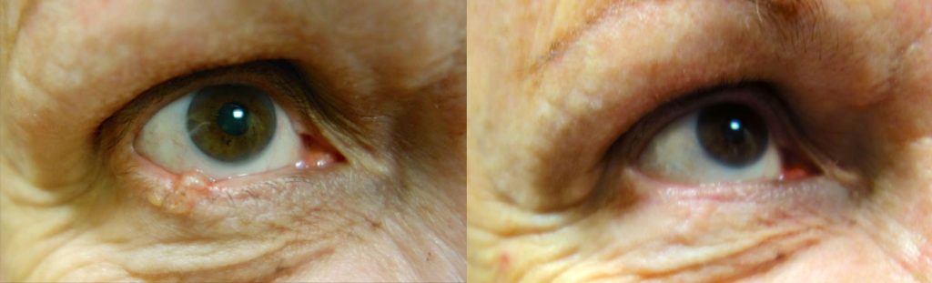 Right Lower Eyelid Basal Cell Cancer Removal with Reconstruction 2 Patient 08-B 