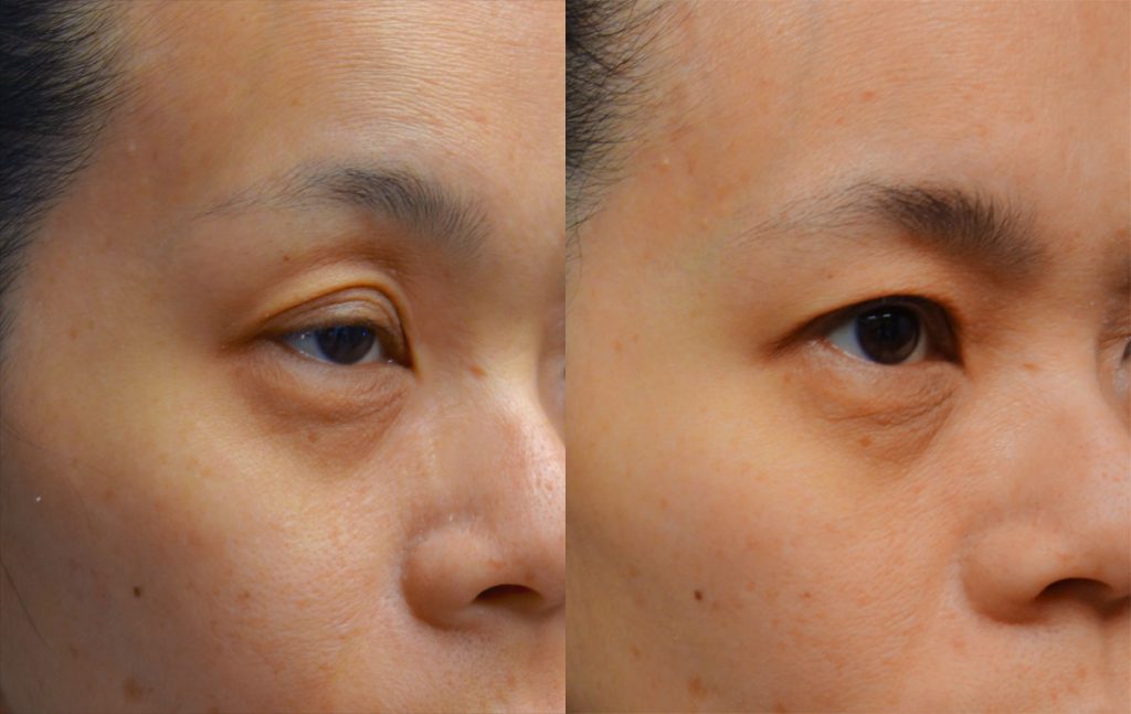 Bilateral Asian Upper Eyelid Blepharoplasty and Ptosis Repair Patient 01-B 