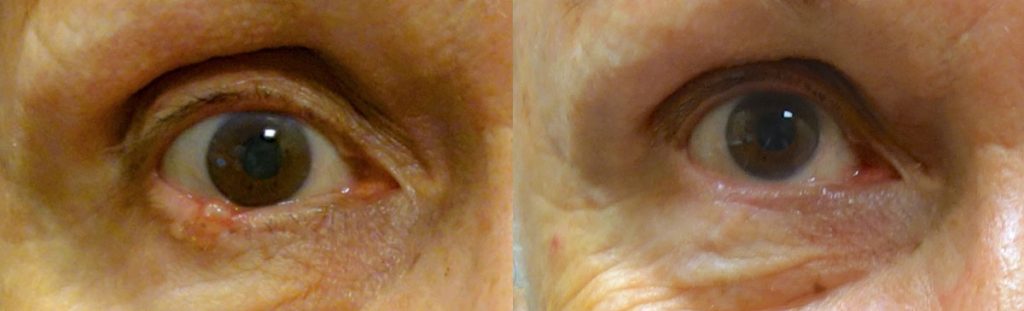 Right Lower Eyelid Basal Cell Cancer Removal with Reconstruction 2 Patient 08-A 