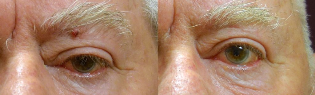 Eyelid Skin Cancer Patient-4
