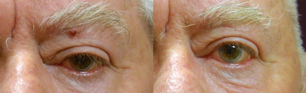 Left Eyebrow Squamous Cell Carcinoma - with Mohs Surgery and Reconstruction Patient 07 