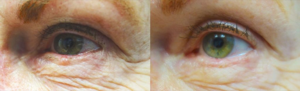 Left Eyelid Basal Cell Carcinoma - Mohs Surgery Patient 06 