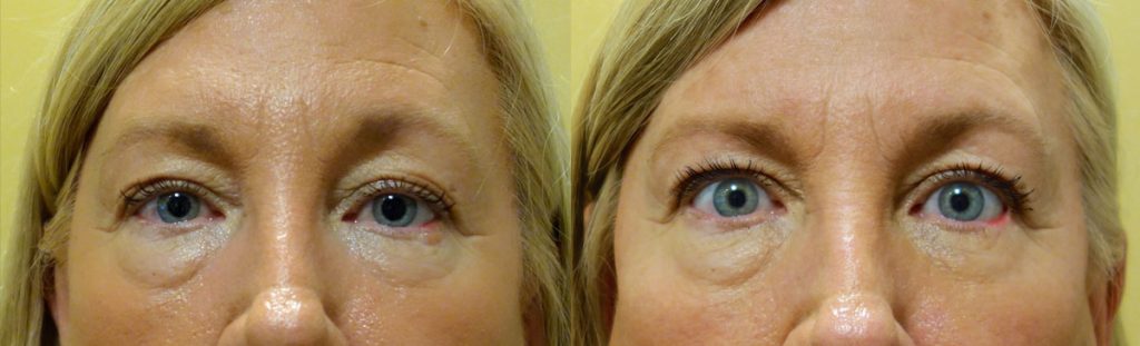 Eyelid Skin Cancer Patient-6