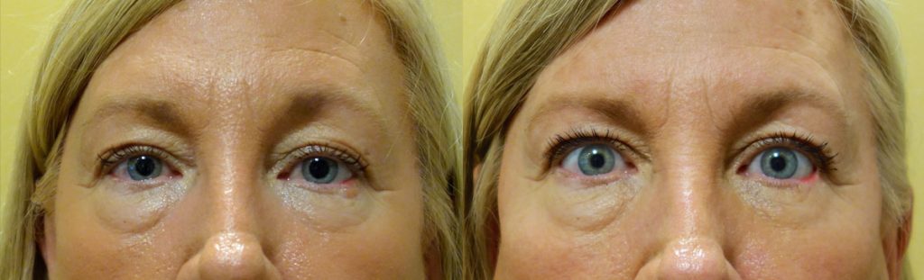 Left Lower Eyelid Reconstruction - Mohs Surgery - 2 Stage Reconstruction Patient 05-A 