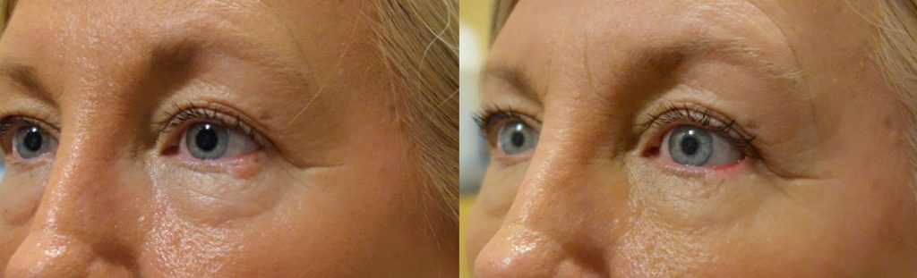 Left Lower Eyelid Reconstruction - Mohs Surgery - 2 Stage Reconstruction Patient 05-B 