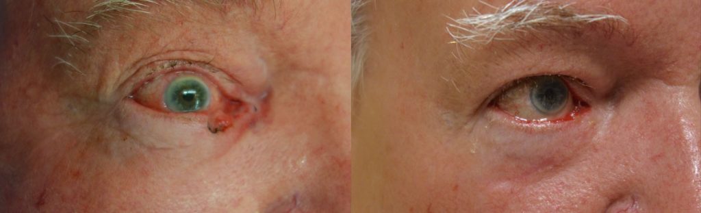 Right Lower Eyelid Basal Cell Carcinoma - Reconstruction After Mohs Surgery with Tear Drain Repair Patient 04-B 