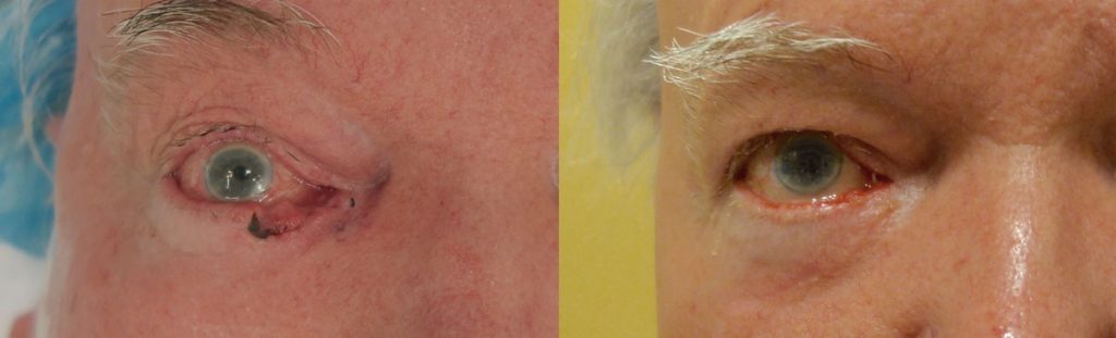 Right Lower Eyelid Basal Cell Carcinoma - Reconstruction After Mohs Surgery with Tear Drain Repair Patient 04-A 