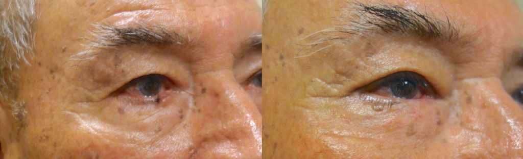 Eyelid Skin Cancer Patient-8