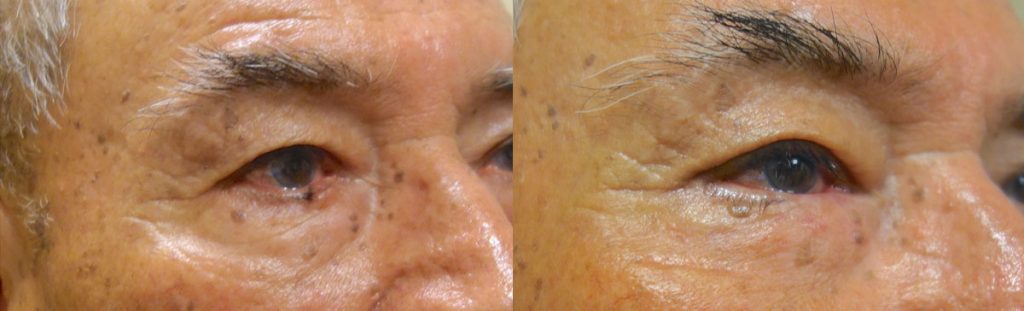 Right Lower Eyelid Basal Cell Carcinoma with (Multiple Stage) Reconstruction Patient 03-B 