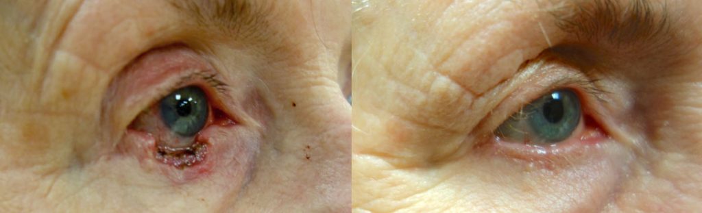 Right Lower Eyelid Mohs Surgery for Basal Cell Carcinoma with Reconstruction Patient 02-B 