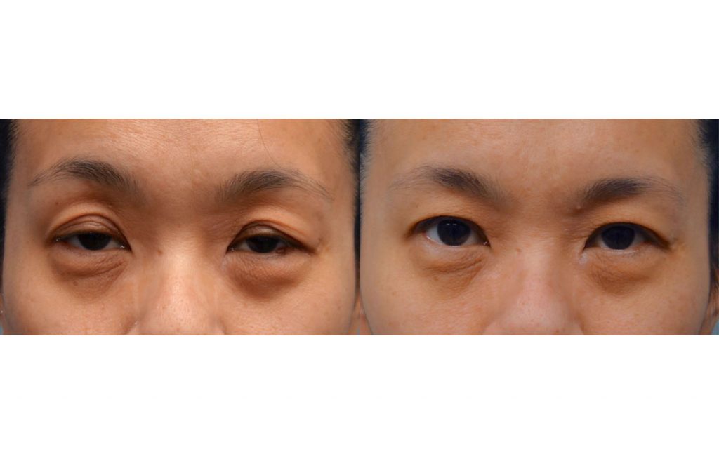 Bilateral Asian Upper Eyelid Blepharoplasty and Ptosis Repair Patient 01-A 