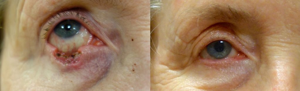 Right Lower Eyelid Mohs Surgery for Basal Cell Carcinoma with Reconstruction Patient 02-A 