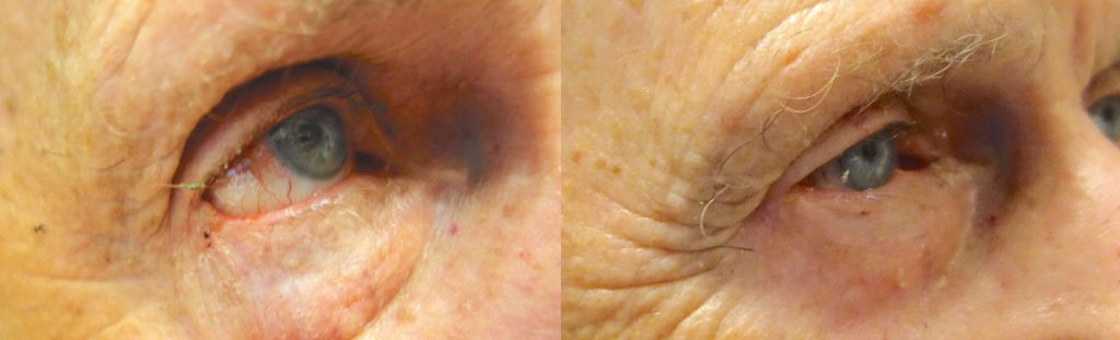 Right Lower Eyelid Mohs Surgery for Basal Cell Carcinoma with Reconstruction Patient 01-B 