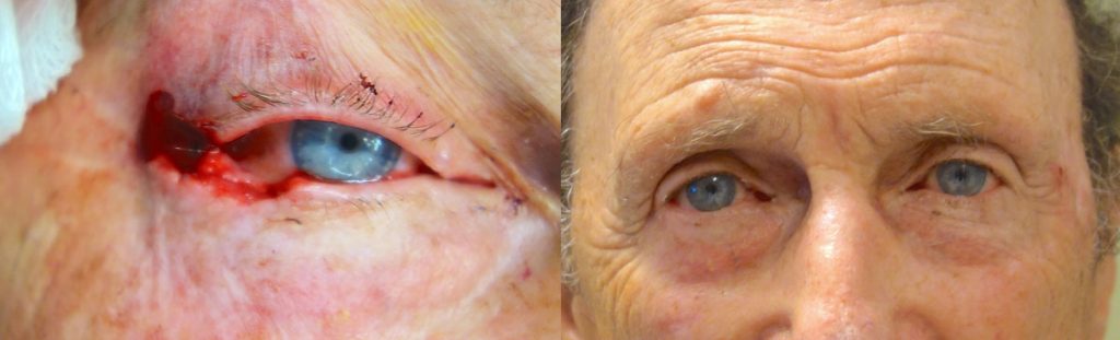 Right Lower Eyelid Mohs Surgery for Basal Cell Carcinoma with Reconstruction Patient 01-A 