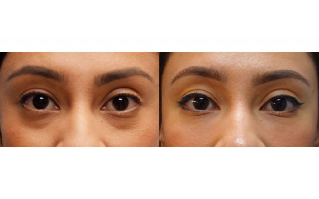 Bilateral Lower Eyelid Filler Patient 04-B 