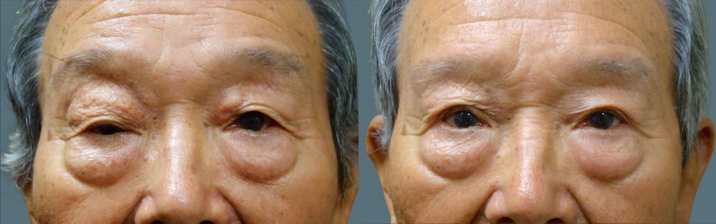 Bilateral Upper Eyelid Blepharoplasty, Right Upper Eyelid External Ptosis Repair - Revision Of Prior Surgery Patient 05-A 