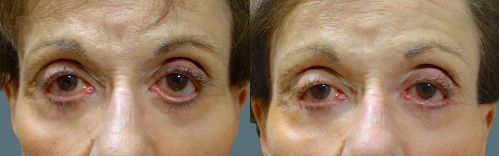 Eyelid Hollowing and Retraction After Lower Eyelid Blepharoplasty - Repaired with Minimally Invasive Revision Surgery Patient 04-A 