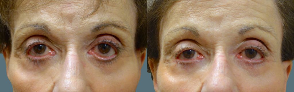 Eyelid Hollowing and Retraction After Lower Eyelid Blepharoplasty - Repaired with Minimally Invasive Revision Surgery Patient 04-A 