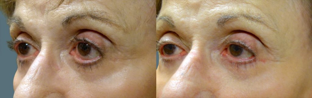 Eyelid Hollowing and Retraction After Lower Eyelid Blepharoplasty - Repaired with Minimally Invasive Revision Surgery Patient 04-B 